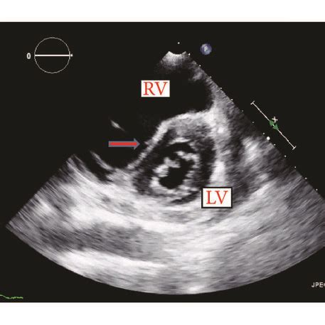 left ventricle d shaped.